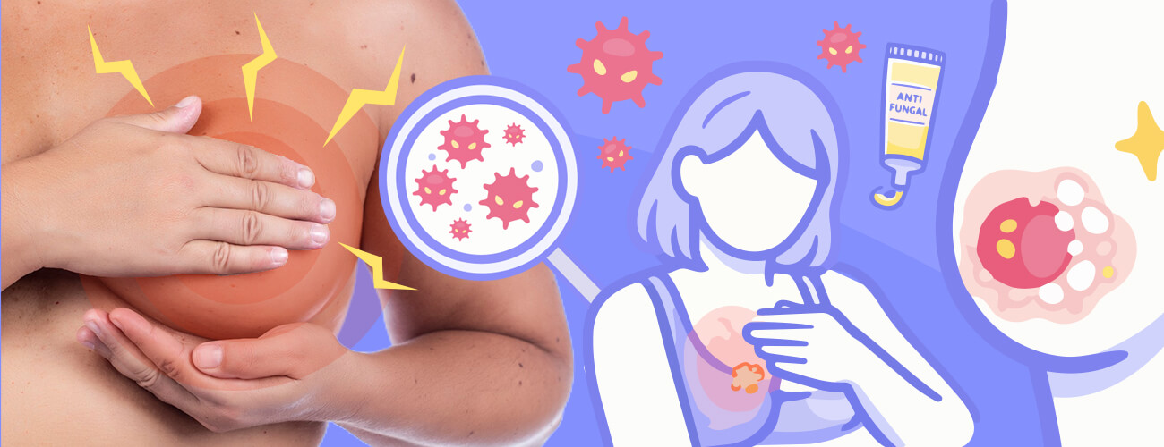 infection candidose mammaire